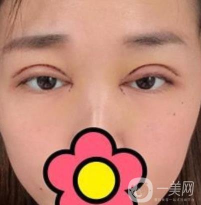 山大二院整形科2020價格表公布,附雙眼皮案例術后*果圖