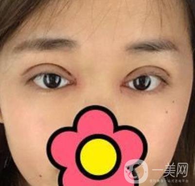 山大二院整形科2020價格表公布,附雙眼皮案例術后*果圖