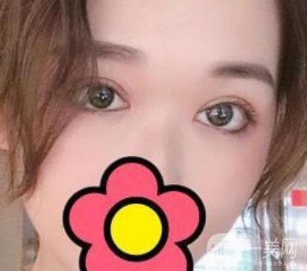 山大二院整形科2020價格表公布,附雙眼皮案例術后*果圖