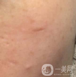 南通大學(xué)附屬醫(yī)院整形科價(jià)格表，附激光去疤案例