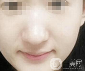 南通大學(xué)附屬醫(yī)院整形科價(jià)格表，附激光去疤案例