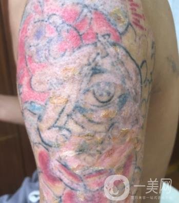 徐州市中心醫(yī)院整形科價格表，附洗紋身案例