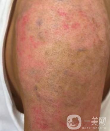 徐州市中心醫(yī)院整形科價格表，附洗紋身案例