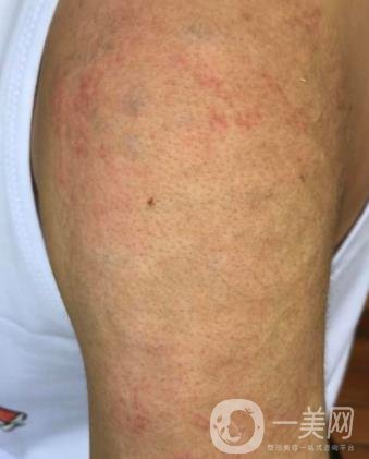 徐州市中心醫(yī)院整形科價格表，附洗紋身案例