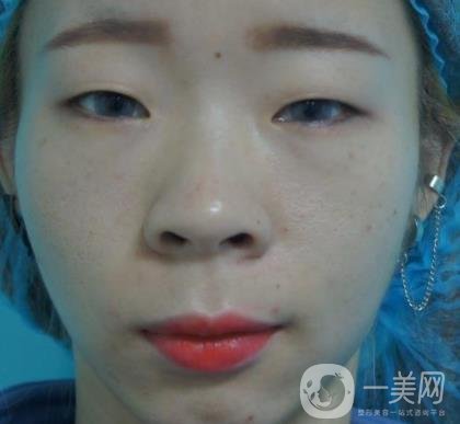 北京彤美醫(yī)療整形醫(yī)院價格表，附桂行軍雙眼皮術后*果一覽