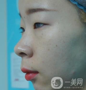 北京彤美醫(yī)療整形醫(yī)院價格表，附桂行軍雙眼皮術后*果一覽