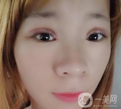 北京彤美醫(yī)療整形醫(yī)院價格表，附桂行軍雙眼皮術后*果一覽