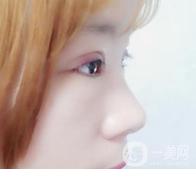 北京彤美醫(yī)療整形醫(yī)院價格表，附桂行軍雙眼皮術后*果一覽