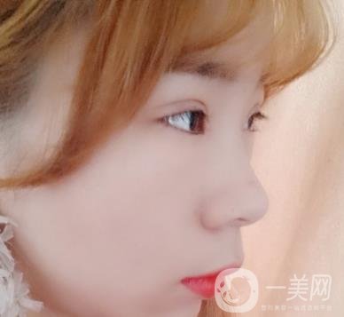 北京彤美醫(yī)療整形醫(yī)院價格表，附桂行軍雙眼皮術后*果一覽