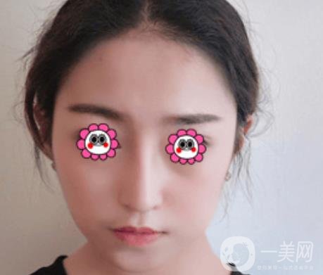 北京圣嘉榮整形價格表，內(nèi)附黃大勇整形醫(yī)生顴骨內(nèi)推案例*果圖展示