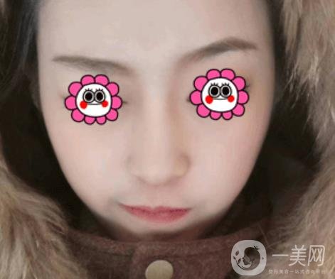 北京圣嘉榮整形價格表，內(nèi)附黃大勇整形醫(yī)生顴骨內(nèi)推案例*果圖展示