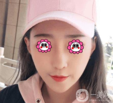 北京圣嘉榮整形價格表，內(nèi)附黃大勇整形醫(yī)生顴骨內(nèi)推案例*果圖展示