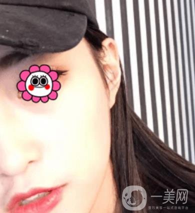 北京圣嘉榮整形價格表，內(nèi)附黃大勇整形醫(yī)生顴骨內(nèi)推案例*果圖展示