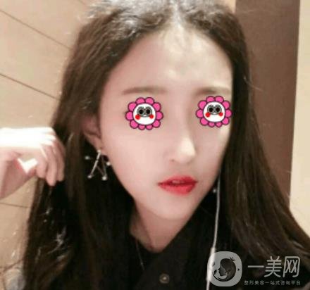 北京圣嘉榮整形價格表，內(nèi)附黃大勇整形醫(yī)生顴骨內(nèi)推案例*果圖展示