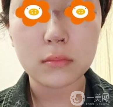 長(zhǎng)沙貝美醫(yī)院做鼻子怎么樣?一覽價(jià)格表費(fèi)用詳情