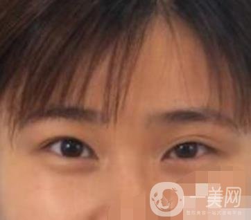 北京韓勛雙眼皮修復怎么樣？附整形價格表一覽