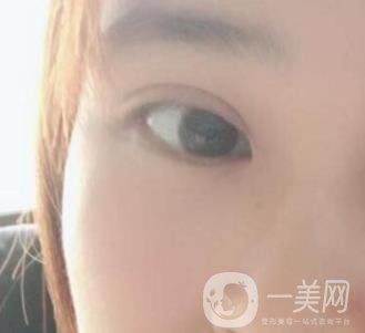 北京韓勛雙眼皮修復怎么樣？附整形價格表一覽