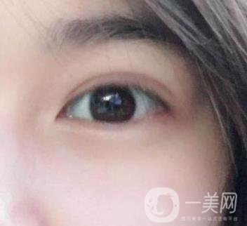 北京韓勛雙眼皮修復怎么樣？附整形價格表一覽