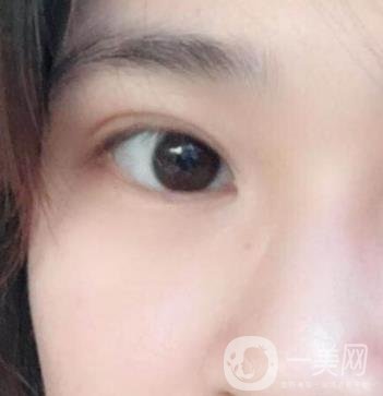 北京韓勛雙眼皮修復怎么樣？附整形價格表一覽