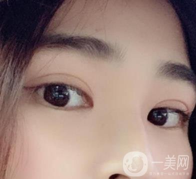 北京韓勛雙眼皮修復怎么樣？附整形價格表一覽
