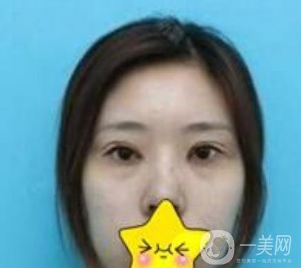 濟寧附屬醫(yī)院做雙眼皮多少錢？附真實案例及整形價格表