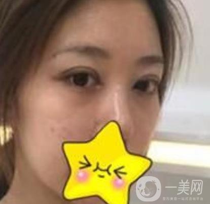 濟寧附屬醫(yī)院做雙眼皮多少錢？附真實案例及整形價格表