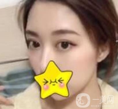 濟寧附屬醫(yī)院做雙眼皮多少錢？附真實案例及整形價格表