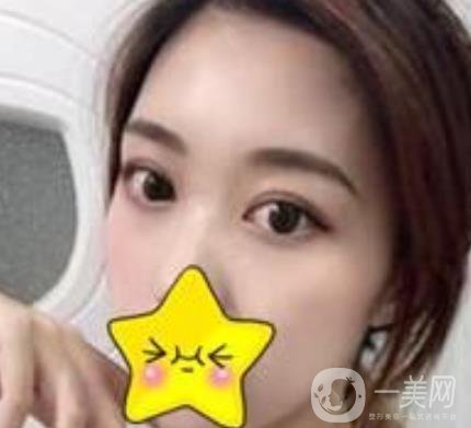 濟寧附屬醫(yī)院做雙眼皮多少錢？附真實案例及整形價格表