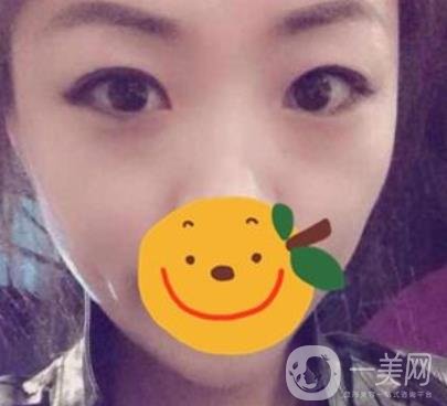 昆明市第一人民醫(yī)院雙眼皮多少錢？附案例及2020全新整形價(jià)格表