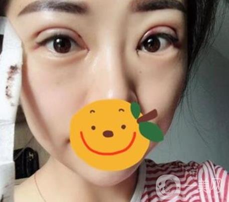 昆明市第一人民醫(yī)院雙眼皮多少錢？附案例及2020全新整形價(jià)格表