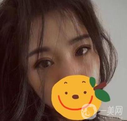 昆明市第一人民醫(yī)院雙眼皮多少錢？附案例及2020全新整形價(jià)格表