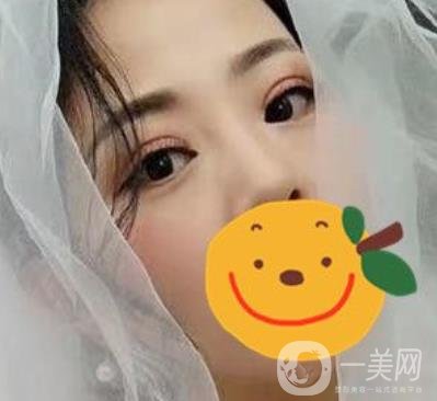 昆明市第一人民醫(yī)院雙眼皮多少錢？附案例及2020全新整形價(jià)格表