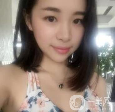 上海王輝醫(yī)生隆鼻