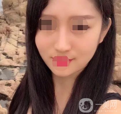 武漢隆鼻醫(yī) 趙星星