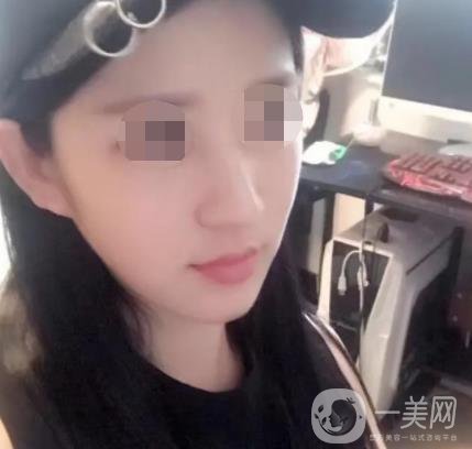 武漢隆鼻醫(yī) 趙星星