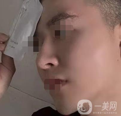 邱健欽醫(yī)生隆鼻