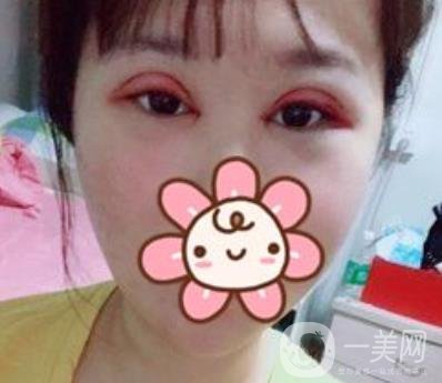 上海華美楊亞益做眼睛多少錢？?jī)r(jià)格表及案例詳情