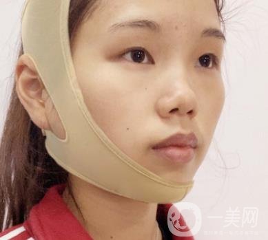 上海時光醫(yī)院何晉龍磨骨怎么樣？價格表及術(shù)后*果分享