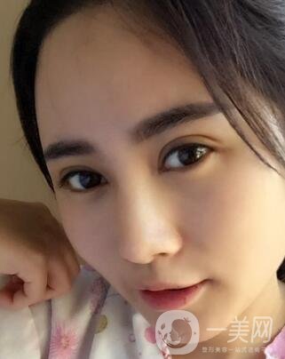 北京處整形外科價(jià)格(目)表2020一覽，附雙眼皮案例