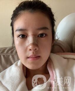 鹽城東方女子整形醫(yī)院價(jià)格表明細(xì)，附隆鼻案例