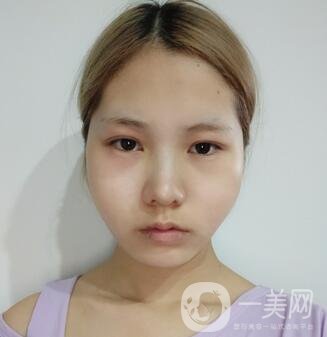 運城中心醫(yī)院整形外科價格表，附顴骨降低案例分享