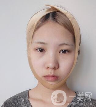 運城中心醫(yī)院整形外科價格表，附顴骨降低案例分享