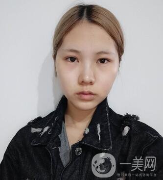 運城中心醫(yī)院整形外科價格表，附顴骨降低案例分享