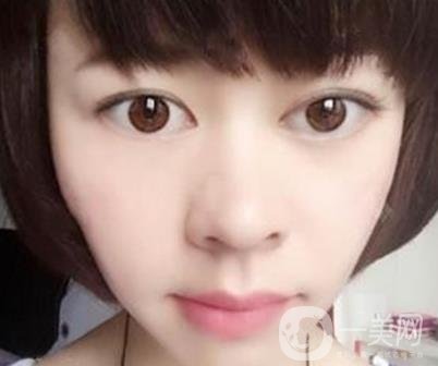 河南省立眼科醫(yī)院做上臉下垂怎么樣?價格表和真人*果圖展示