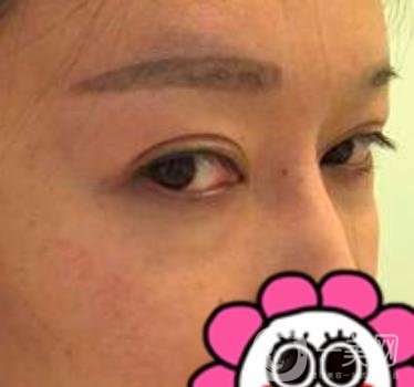 北京友誼醫(yī)院整形科祛眼袋*果好不好？2020年價(jià)格價(jià)目收費(fèi)曝光啦