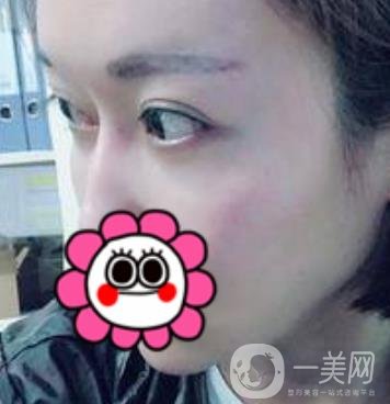 北京友誼醫(yī)院整形科祛眼袋*果好不好？2020年價(jià)格價(jià)目收費(fèi)曝光啦