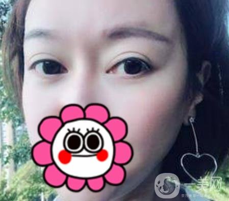 北京友誼醫(yī)院整形科祛眼袋*果好不好？2020年價(jià)格價(jià)目收費(fèi)曝光啦