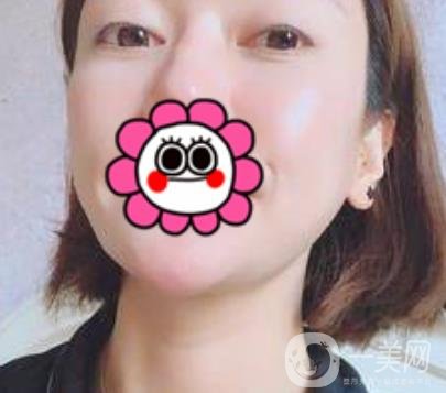 北京友誼醫(yī)院整形科祛眼袋*果好不好？2020年價(jià)格價(jià)目收費(fèi)曝光啦