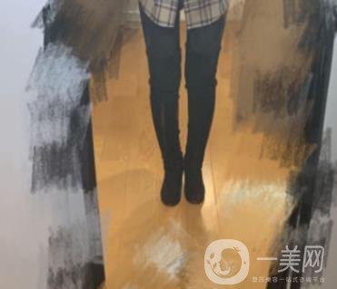 南京檸檬吸脂怎么樣?大腿吸脂案例及整形價格表預(yù)覽