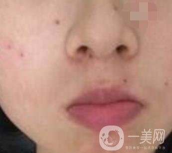 青醫(yī)附院激光去痣多少錢?案例及整形價格表分享